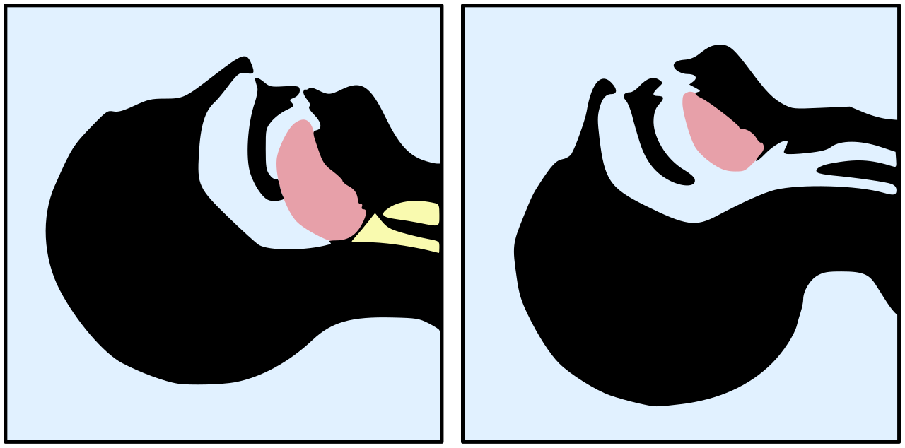 The head-tilt/chin-lift is the most reliable method of opening the airway