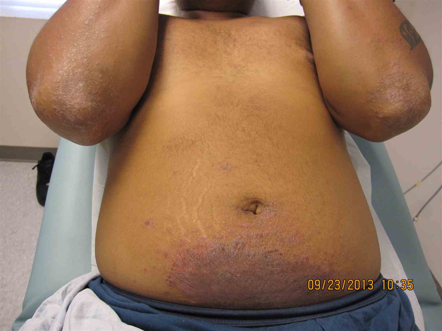 Classic presentation of periumbilical nickel contact dermatitis with id reaction involving elbows