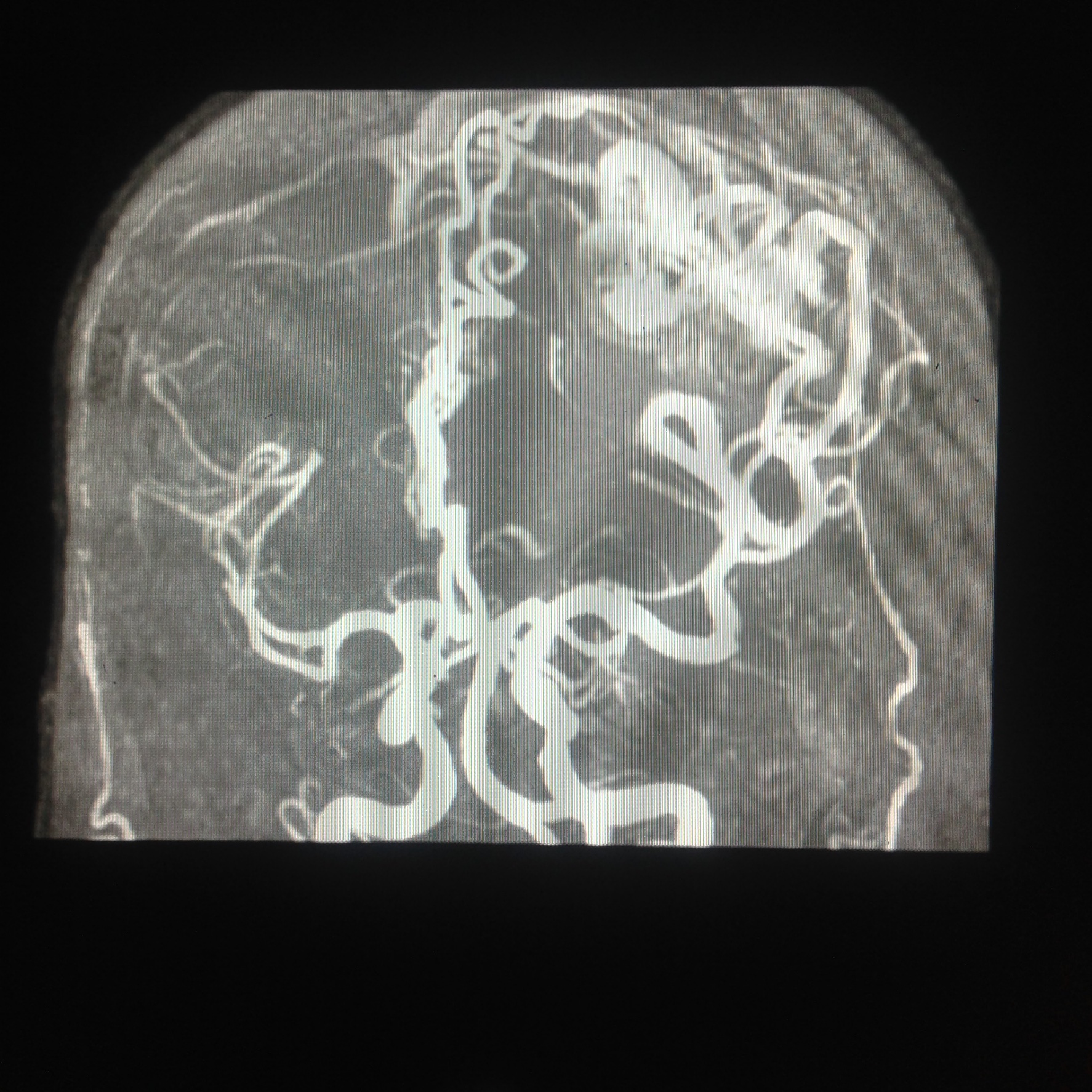 MRA, neovascular bundle receiving supply from middle cerebral artery and early drainage into superficial vein