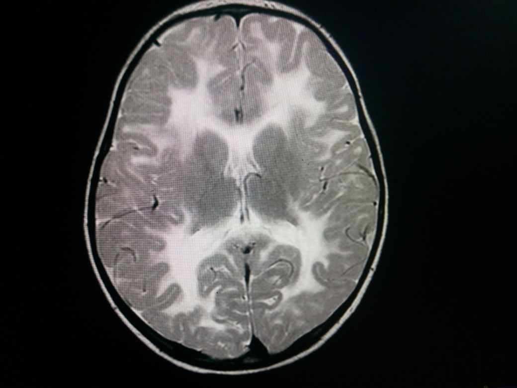 T2W axial slice of brain at level of basal ganglia depicts diffusely  hyperintense signals in white matter extending to the sub cortical U fibres