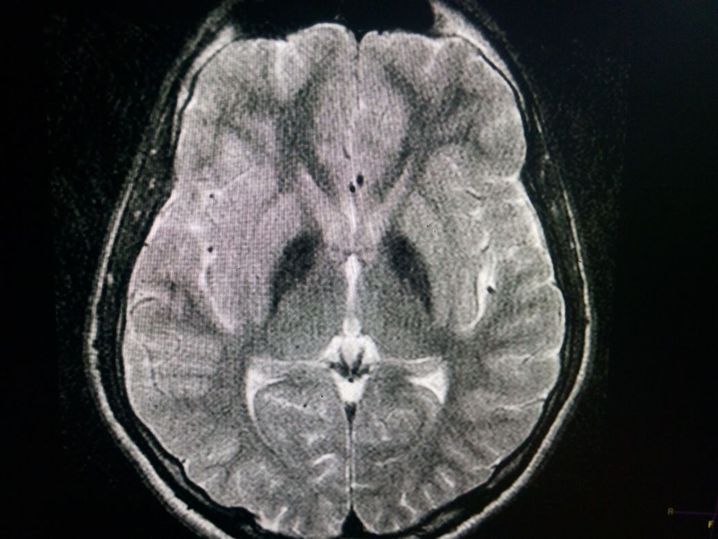 Bilateral  hypointense globi pallidi due to iron deposition in a patient of PKAN  on T2W MRI