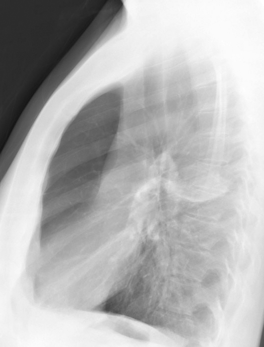 X-ray, COPD, Chronic Obstructive Pulmonary Disease, Bulla, Right Upper Lobe, Lateral 
