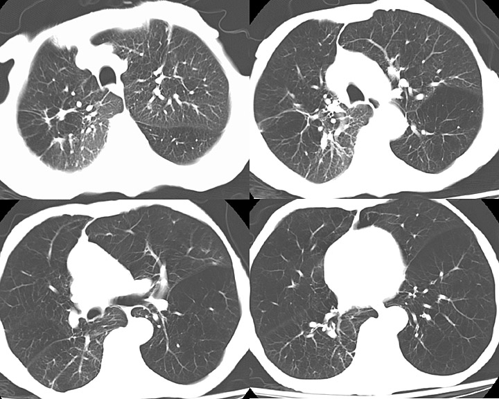 CT Scan, COPD, Chronic Obstructive Pulmonary Disease, Left Lung