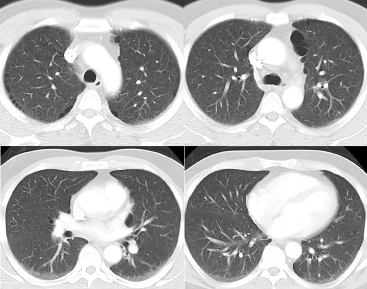 CT Scan, COPD, Chronic Obstructive Pulmonary Disease, Paraseptal Emphysema