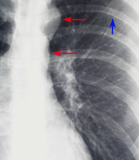 X-ray, Cardiac, Coarctation of the Aorta, Close up