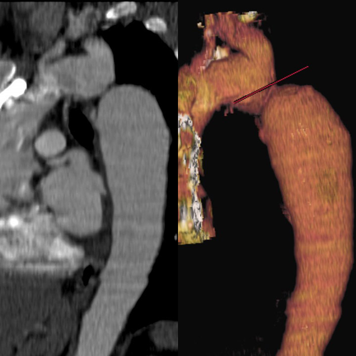 CT Scan, Magnetic Resonance, Cardiac, Coarctation of the Aorta