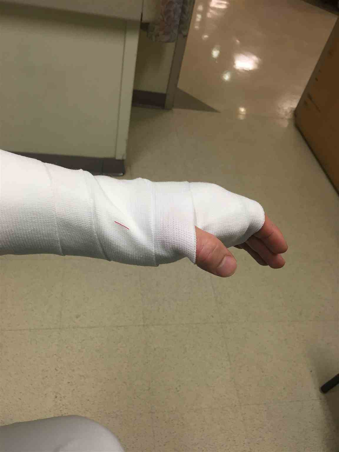 completed splint