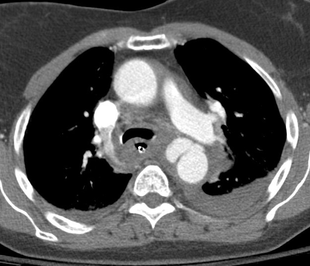 CT Scan, Cardiac, Traumatic Aortic Injury