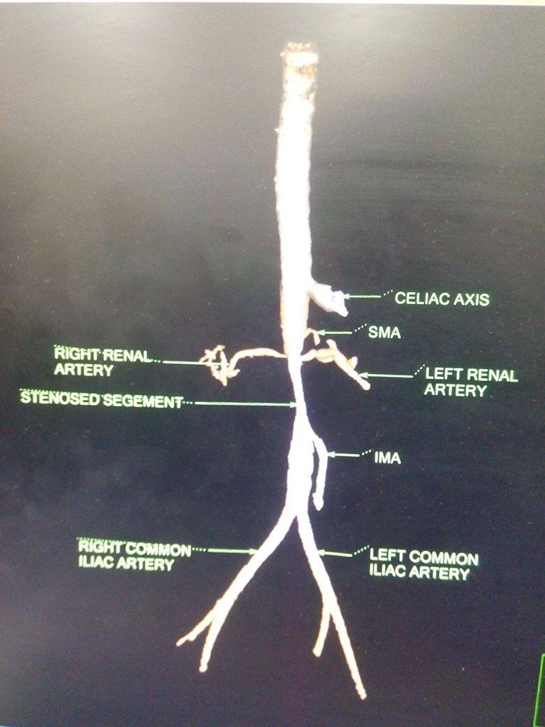 Takayasu Arteritis, Renal Artery Stenosis Bilaterally
