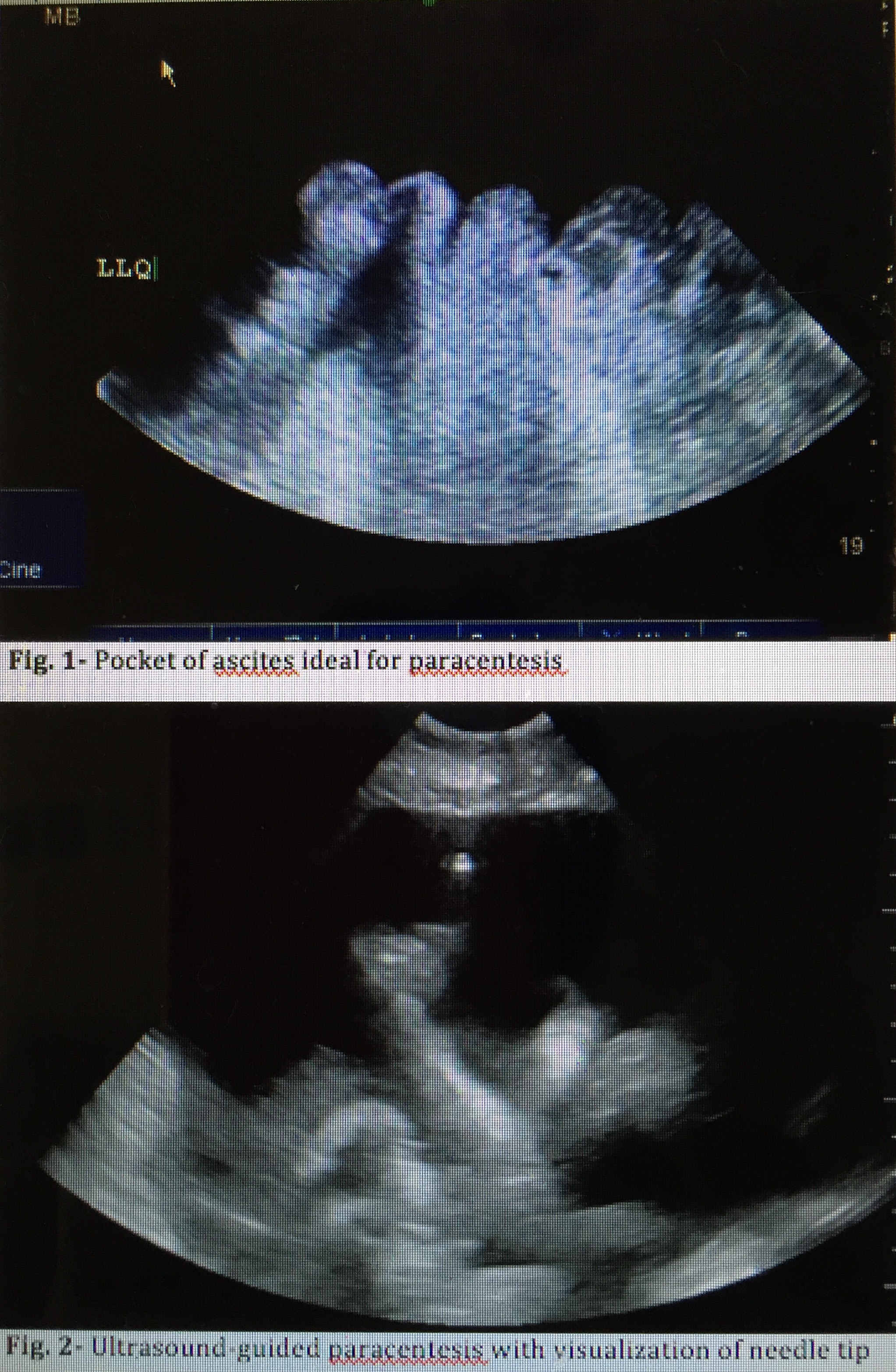 Uses of ultrasound for paracentesis