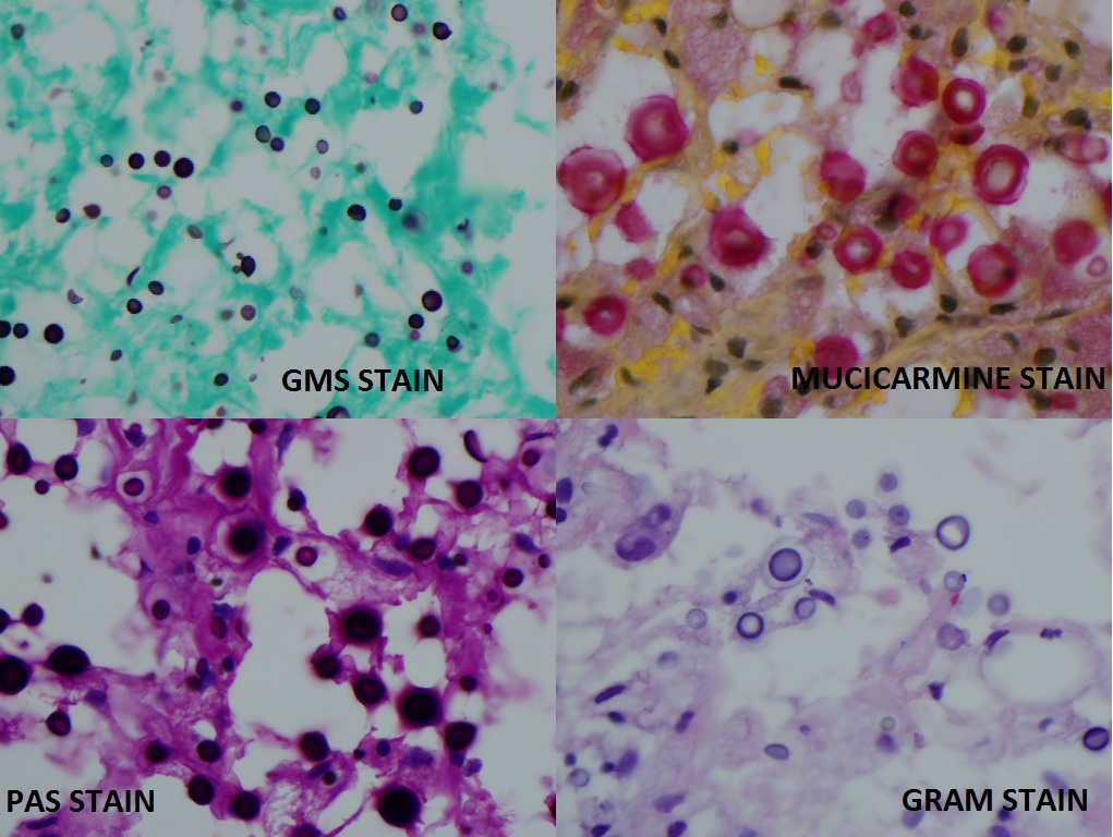 Cryptococcus showed in different fungal stains