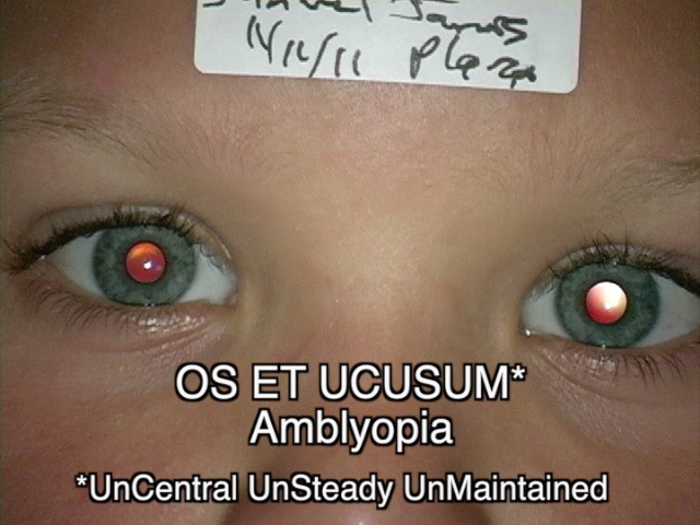 left esotropia therefore amblyogenic condition amblyopia confirmed by poor fixation UCUSUM