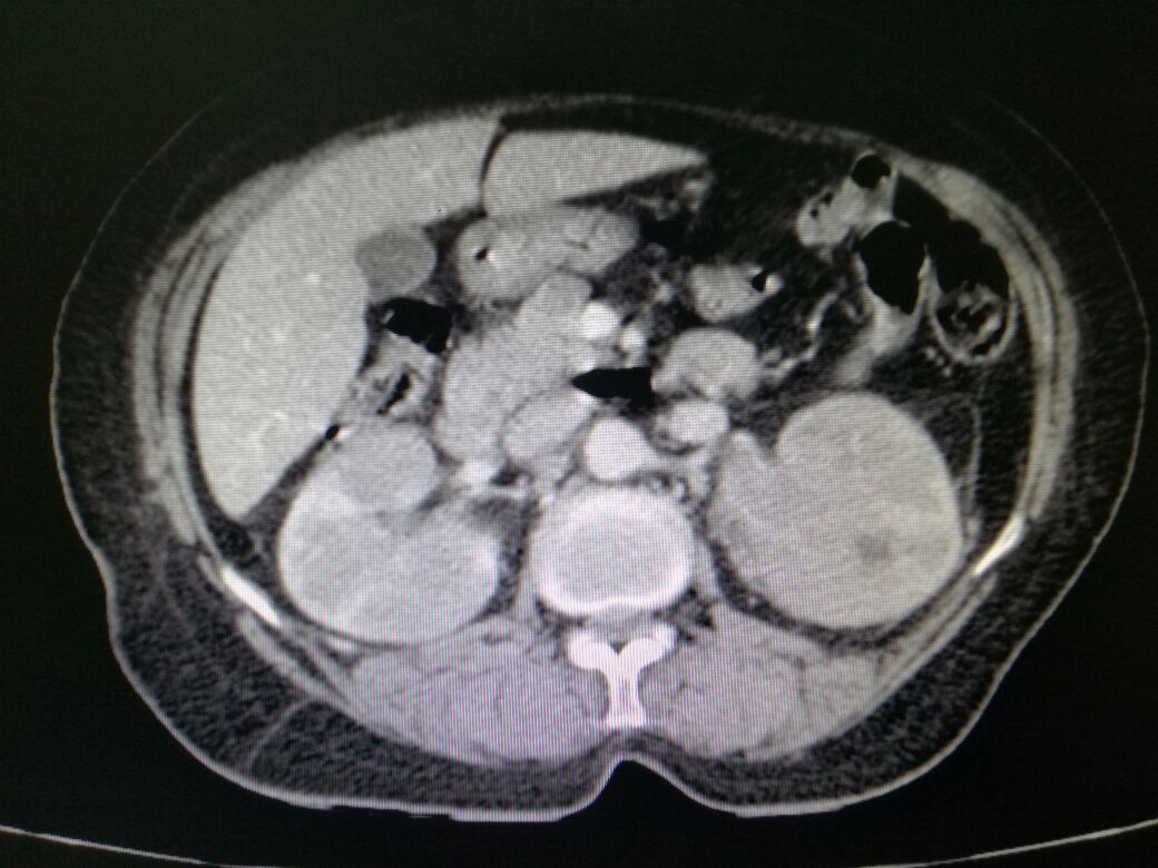 Bilateral multinodular renal presentation of disseminated non Hodgkin disease seen on post contrast CT scan