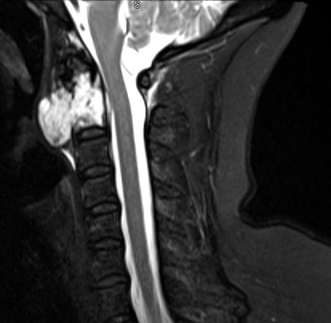 A sagittal T2 fat saturation MRI image showing a chordoma arising from C2 vertebral body and growing exophytically.
