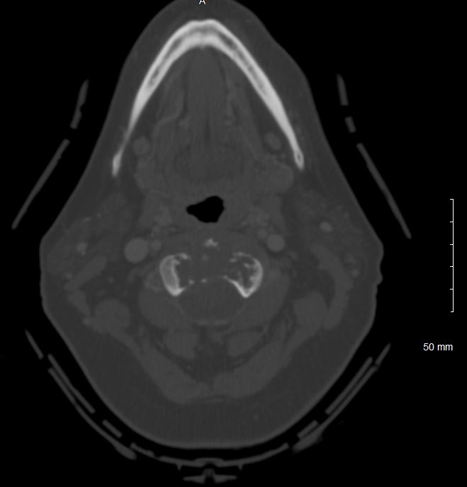 An axial CT of the cervical spine with contrast demonstrating a lytic destruction of the C2 vertebral body from a chordoma.