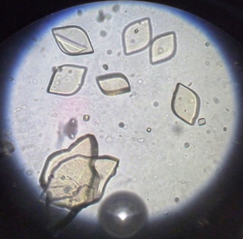 Uric acid Crystals in Urine