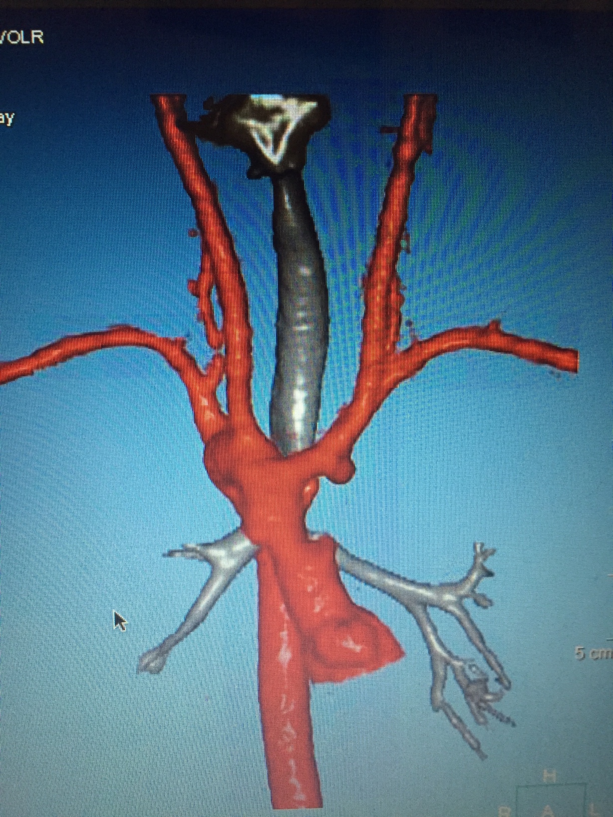 Right aortic arch with mirror image branching.  Ductal ampulla noted originating from underside of left innominate artery.