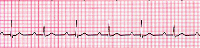 First Degree Heart Block Rhythm Strip, ECG, EKG, Cardiac 