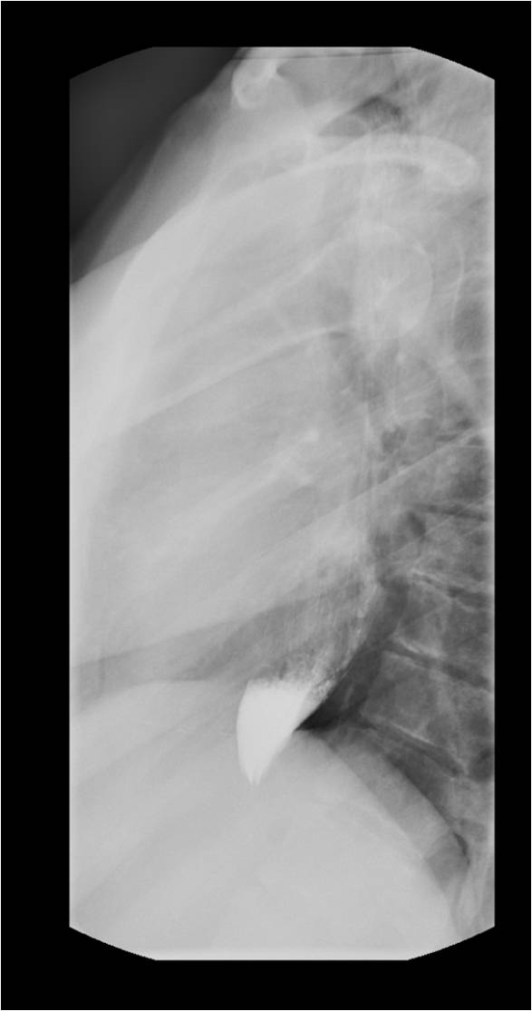 Beaklike narrowing of the distal esophagus with proximal distension, achalasia