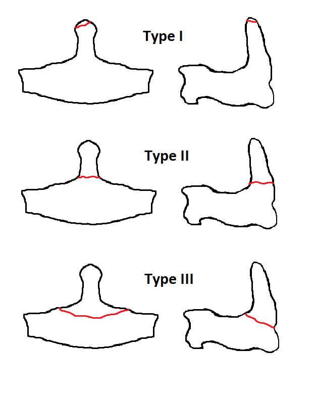 Anderson and D'Alonzo classification of odontoid fractures.