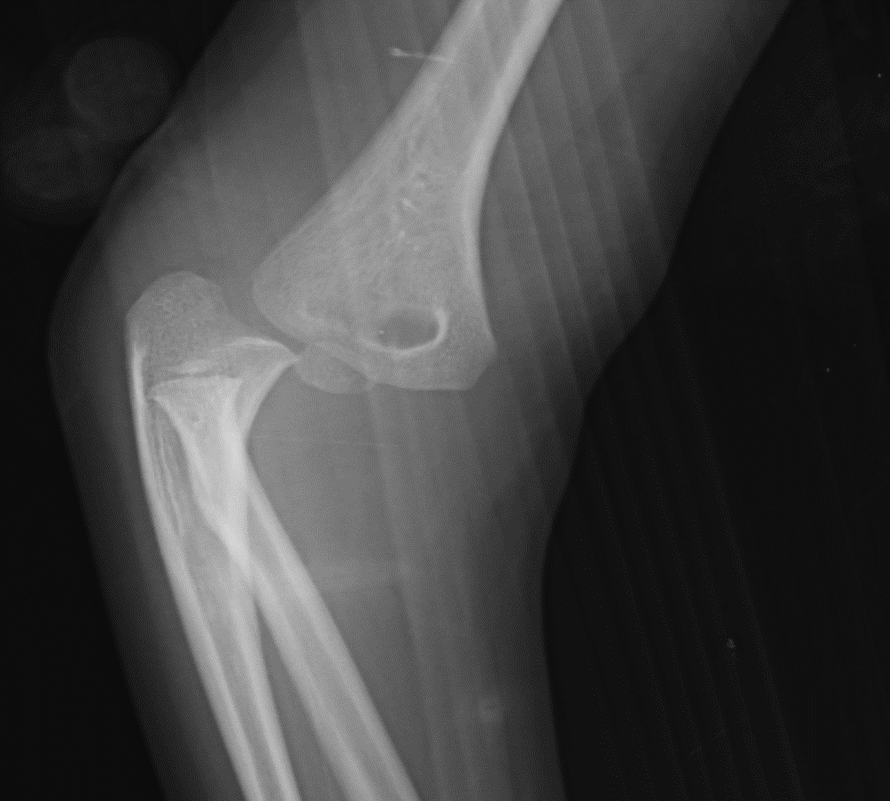Elbow fracture (Posterior dislocation)