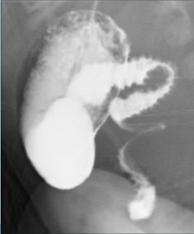 Abnormal C-loop & corkscrew appearance of jejunum 
