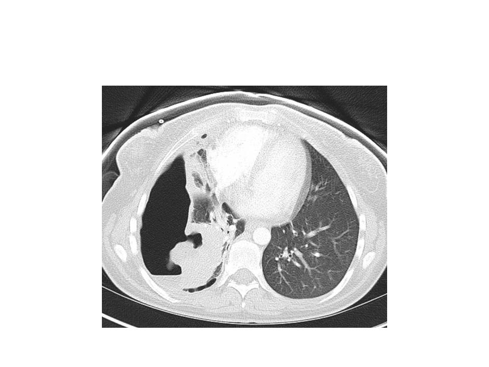 CT chest with contrast showing large right sided cavitary lung lesion with hydropneumothorax and collapsed lung in an AIDS patient due to Rhodococcus equi. The organism was isolated from blood, sputum and pleural fluid.