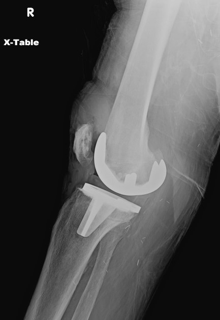Plain radiograph of the right knee in a 78 year old man with prosthetic joint infection 10 years after initial surgery. The route of infection is most likely hematogenous.