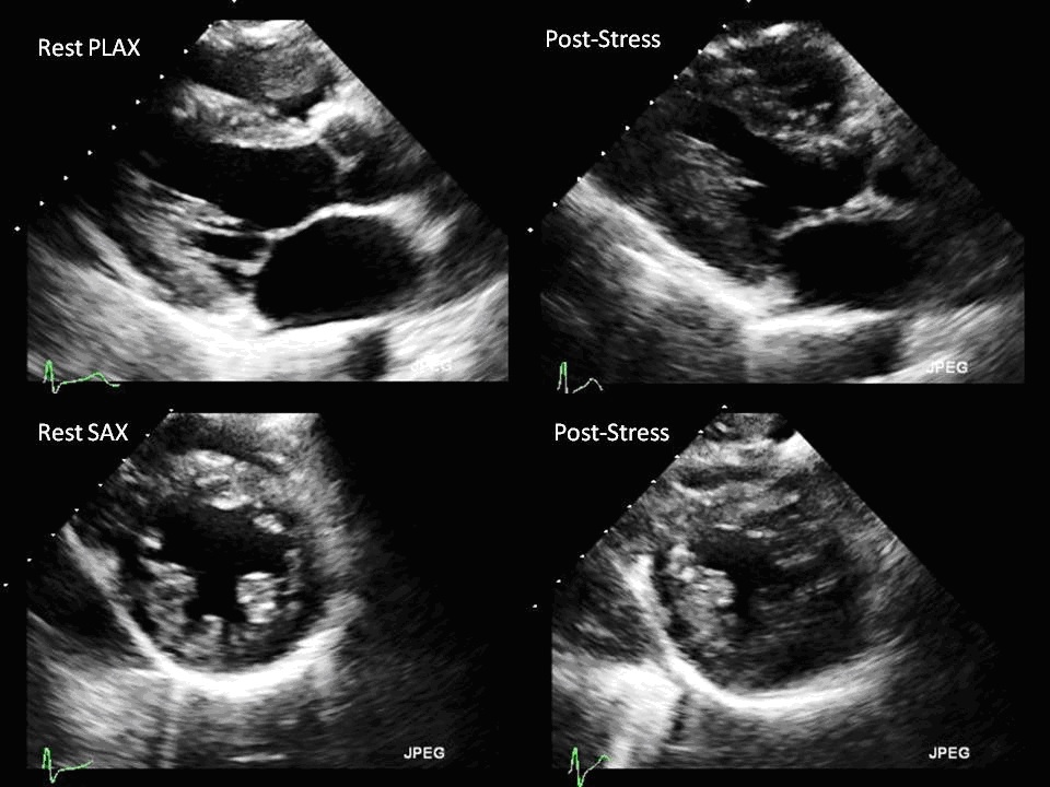 Above images are obtained at resting phase and post stress phase which are then compared for interpretation of left ventricular size, shape and function 