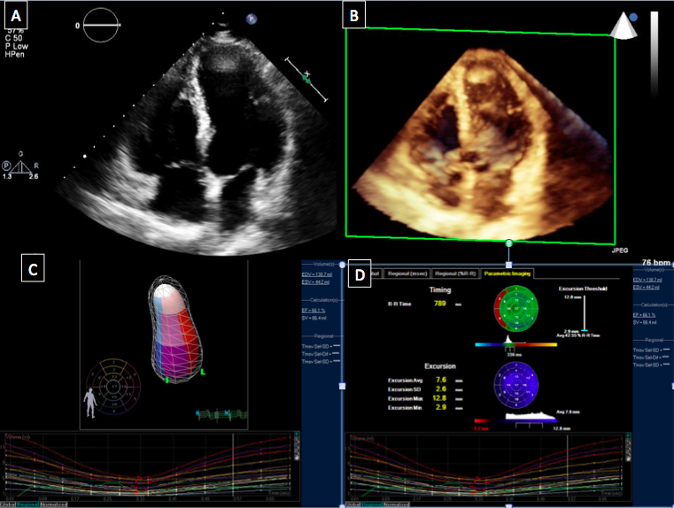 Echocardiography is central to cardiac imaging. (A) shows an apical 4 chamber two-dimensional transthoracic image. (B) shows an apical 4 chamber three-dimensional transthoracic image. (C) and (D) show the quantification of ventricular volume and function that is made possible by 3-dimensional imaging and advanced quantitation packages
