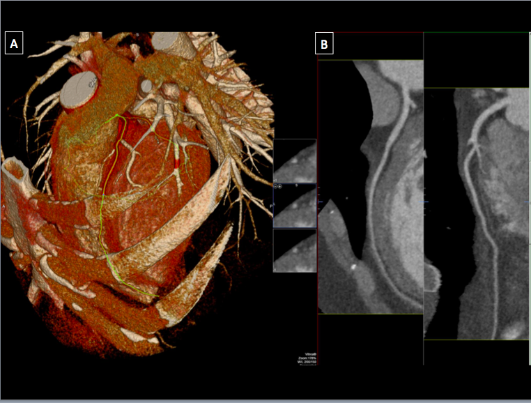 Computed tomography imaging of the heart in (A) showing a 3-dimensional volume rendered image of the heart and surrounding ch