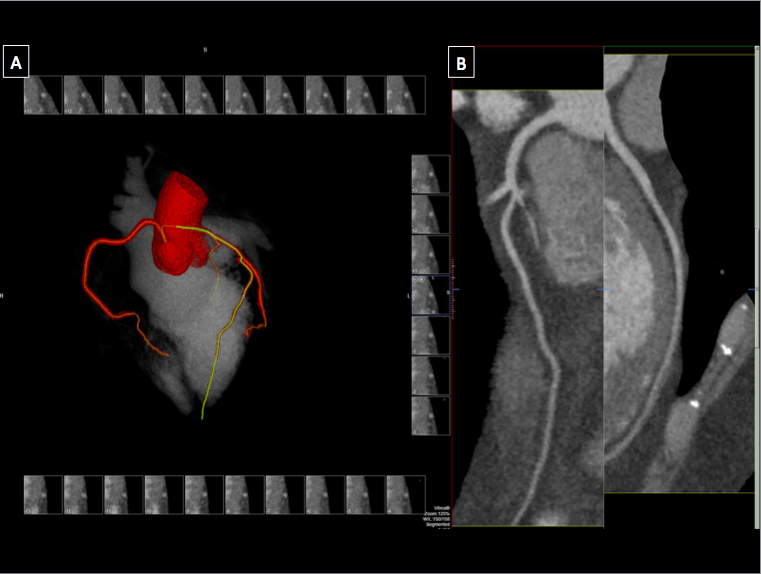 Computed tomography imaging of the heart in (A) showing a 3-dimensional volume rendered image of the coronary tree and left h
