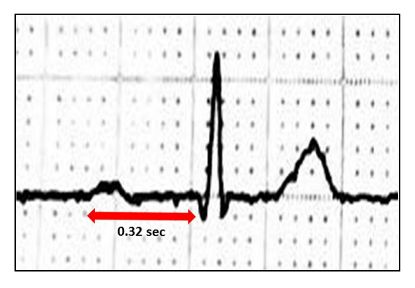 EKG, cardiac complex noting a significantly prolonged PR interval (0.32 seconds) consistent with first degree AV Block