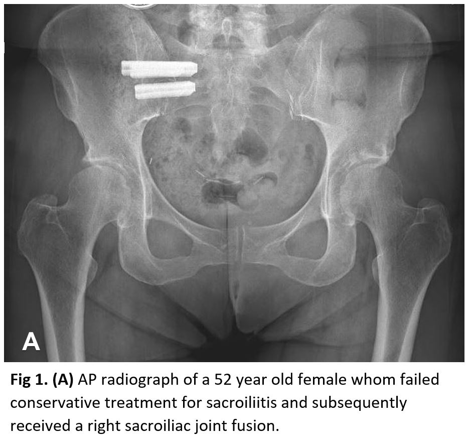 Anteroposterior Radiograph, Sacroiliitis, Right Sacroiliac Joint Fusion