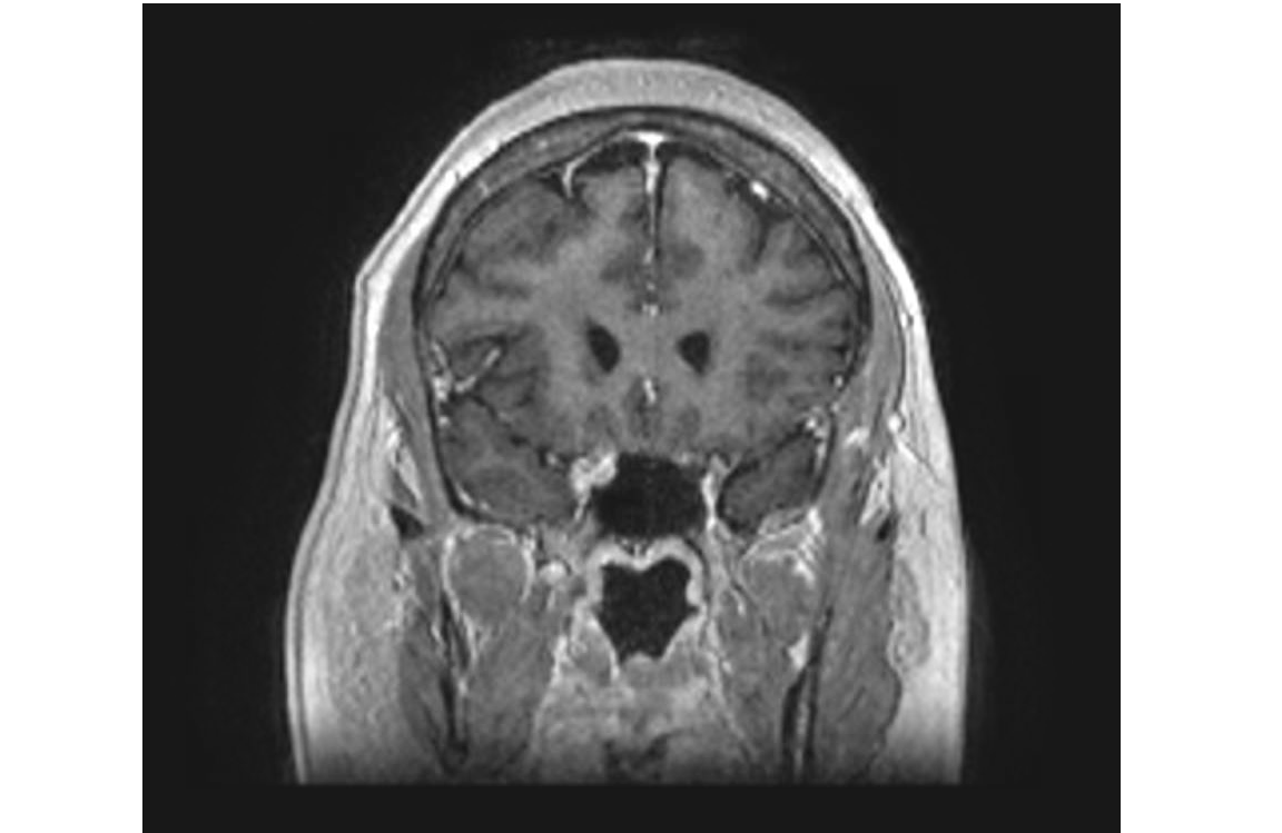 Coronal T1 with contrast on MRI Brain in Tolosa-Hunt Syndrome