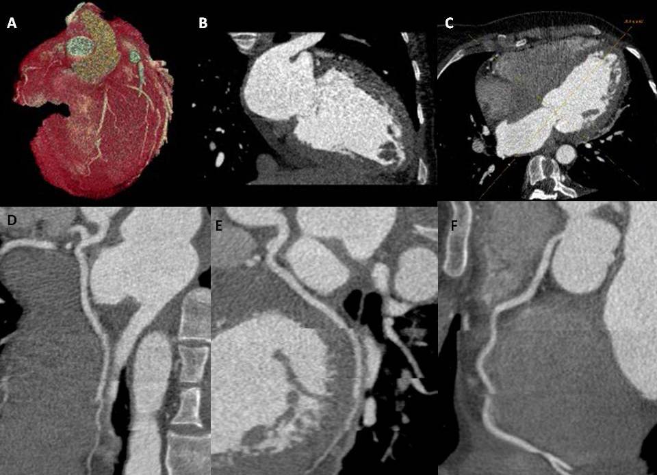  CCTA imaging, (A) represents a three-dimensional volume rendered image of the heart, (C); represent oblique planar images of the heart,  (B) at the apex, likely consistent with an intracavitary thrombus. (D), (E), and (F) represent multiplanar reformatted images of the left anterior descending artery (D), left circumflex artery (E), and right coronary artery (F) respectively