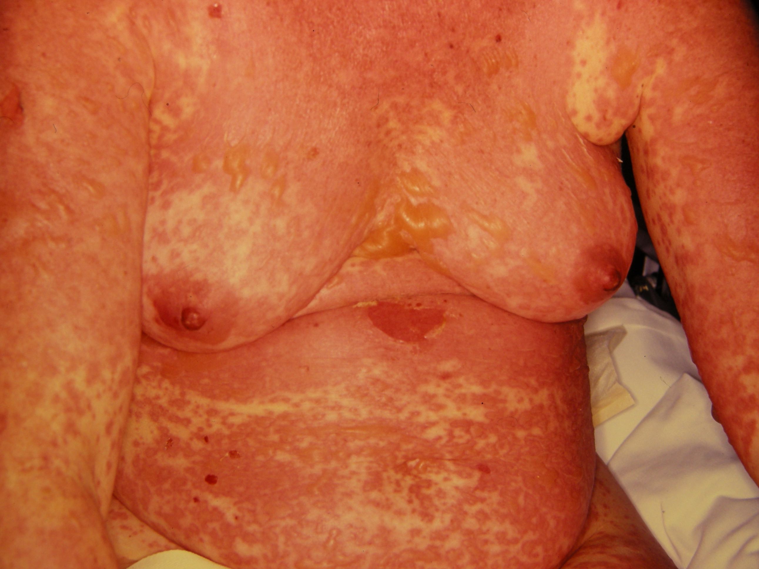 Widespread early morbilliform eruption with flaccid bullae in patient with toxic epidermal necrolysis