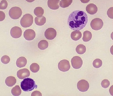 Macrocytic anemia