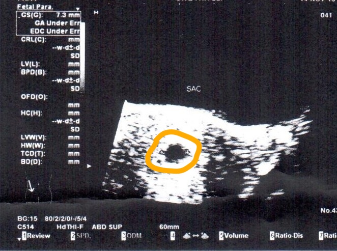 Final Transabdominal Ultrasound  at 8 weeks, shows 
gestational sac 7.3 mm with no fetus
