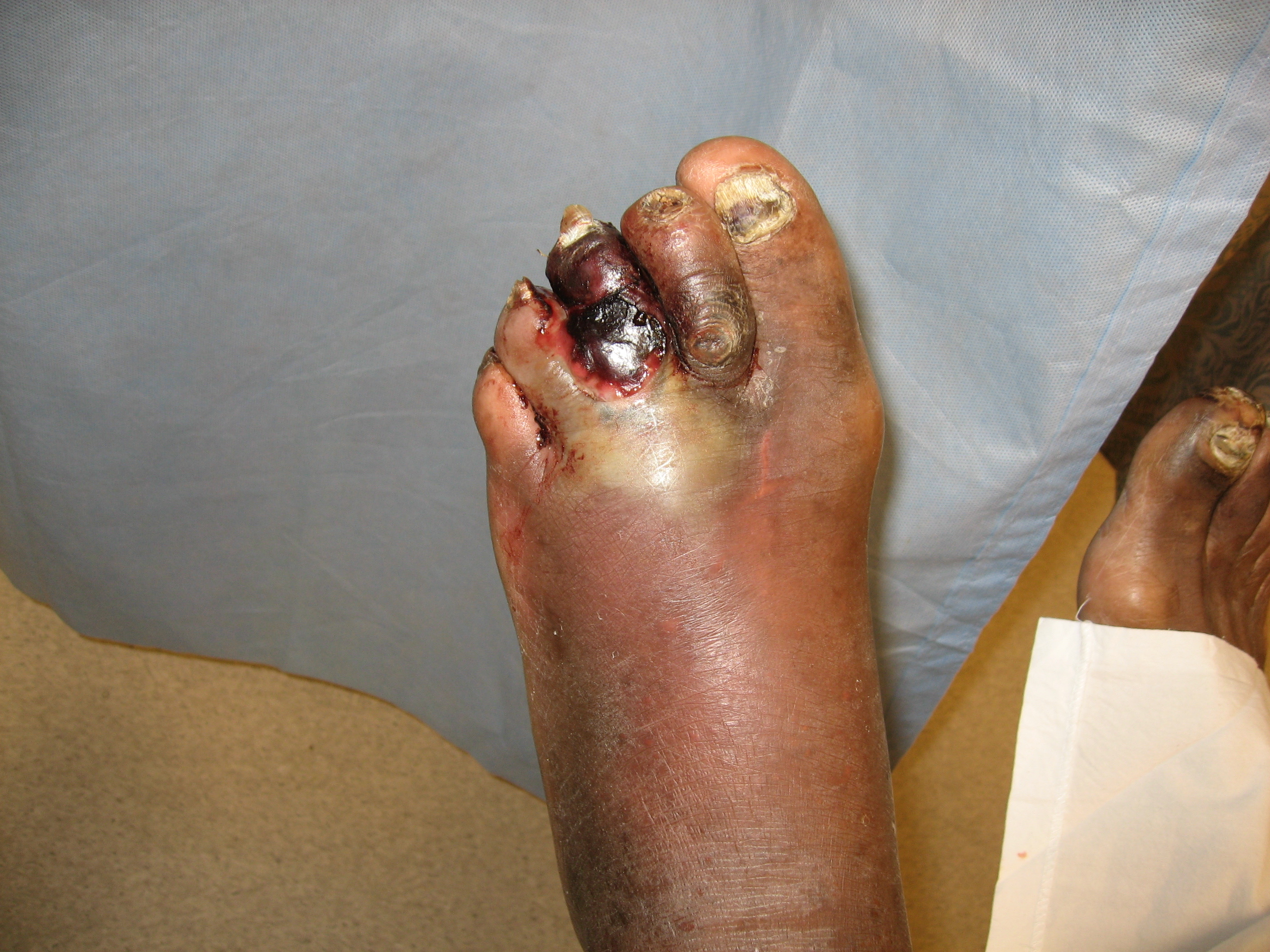 Gas gangrene of a diabetic foot