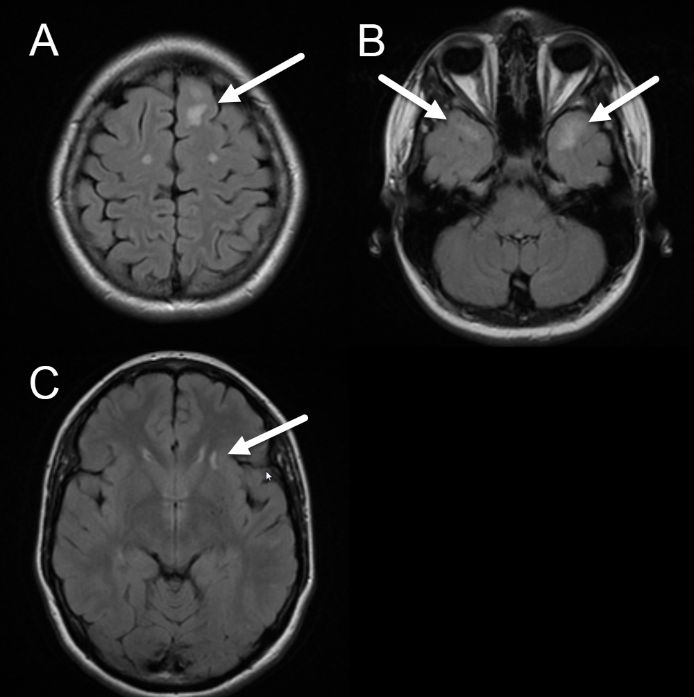 Axial FLAIR images demonstrating the characteristic appearance of CADASIL. White arrows highlight white matter lesions in the paramedian superior frontal (A), anterior temporal (B), and external capsule (C) subcortical white matter.