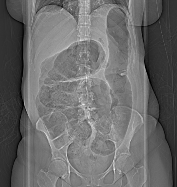 Figure 1: Abdominal xray of a cecal volvulus revealing a dramatic dilation of bowel extending from the right lower quadrant moving upwards to the left upper quadrant of the abdomen. 