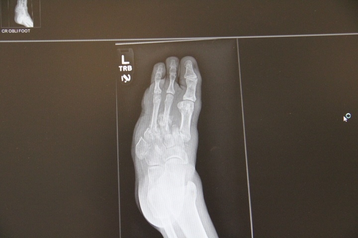 Radiograph of foot demonstrating Developmental Stage of Charcot