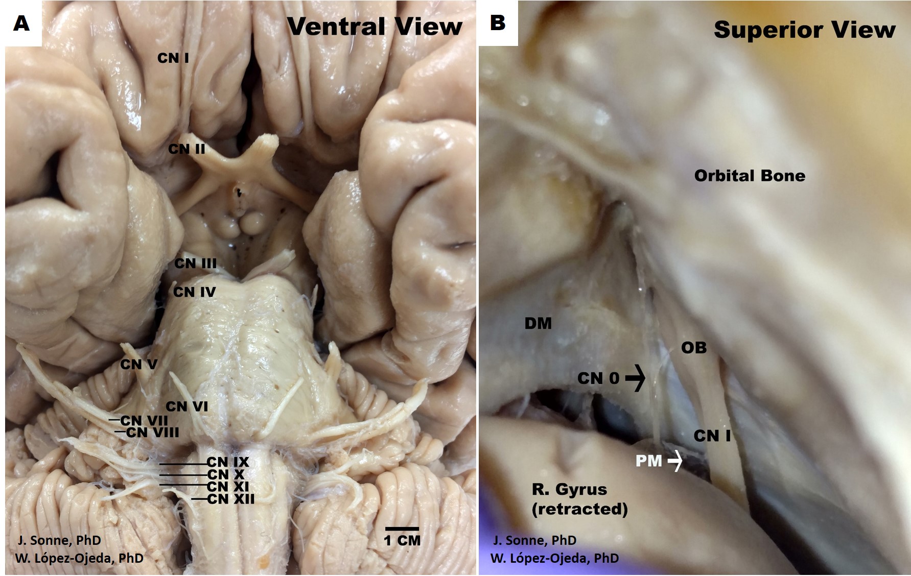 Figure 1A-B. Human brain cranial nerves. A. Ventral view of the human brain depicting the canonical organization of the 12 pairs of cranial nerves (CN) as described in the classical medical nomenclature, Roman numerals (I-XII) are used in progressive order to identify the rostro-caudal organization of the 12 pairs of cranial nerves, B. Superior view of the human skull and frontal brain lobe following a special dissection procedure to reveal the intact cranial nerve zero (CN 0) (black arrow). DM= dura matter, OB= olfactory bulb, PM= pia matter.