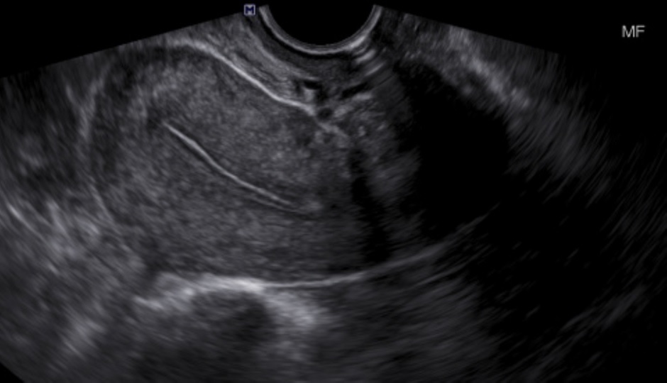 TV long image of a normal uterus. Note the bladder is not fluid filled nor readily visible