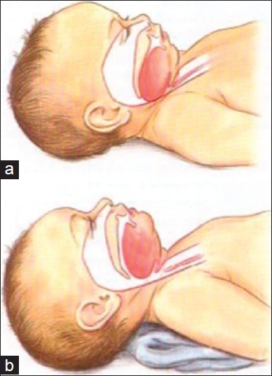 Figure 1: Artistic rendering of infant airway. (a) In image a note the large occiput which has caused flexion of the head and subsequently caused the base of the tongue to obstruct the upper airway. This obstruction has been relieved (b) by placing a towel under the shoulders and neck allowing more extension of the head and an opening of the upper airway