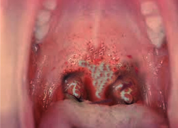 diphtheria oral cavity