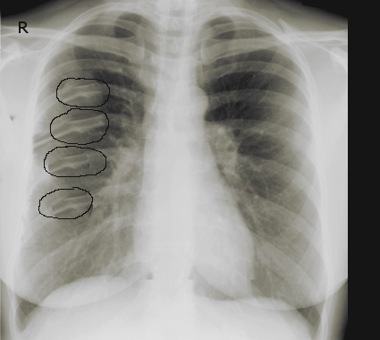Consecutive rib fractures following blunt trauma