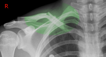 clavicle fracture after a fall from a ladder
