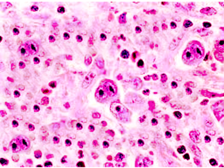 Reed Sternberg Cells Lymphoma